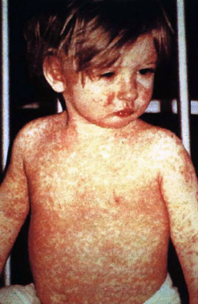 A child with the classic fourth-day measles rash, in an undated photograph from the US Centers for Disease Control and Prevention.